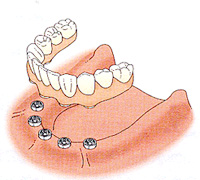 インプラント義歯